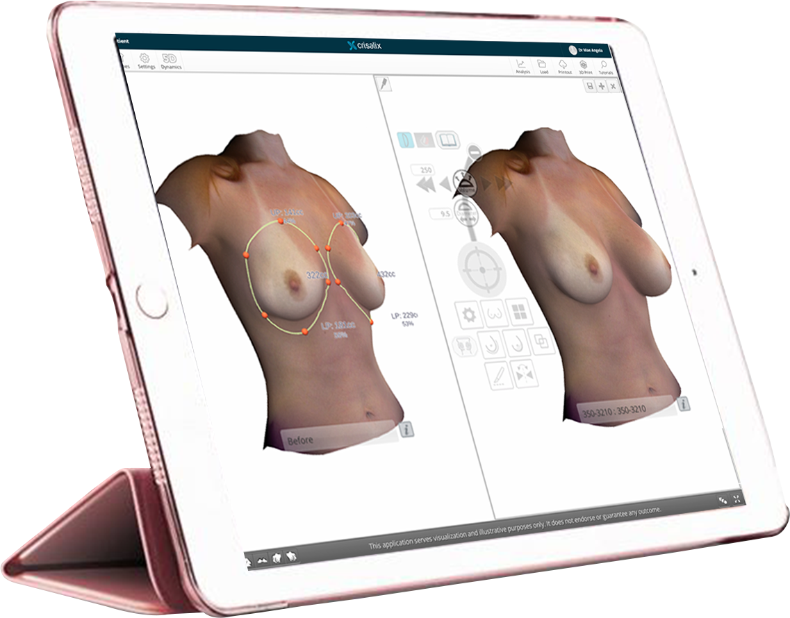 Interface Crisalix sur iPad avec simulation 3D personnalisée