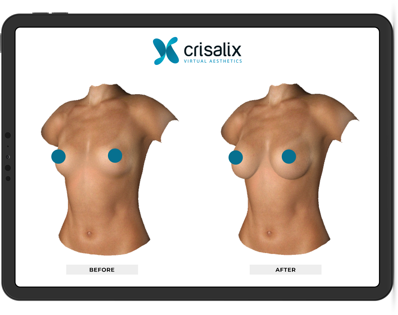 Exemple de simulation 3D Crisalix avant et après sur tablette